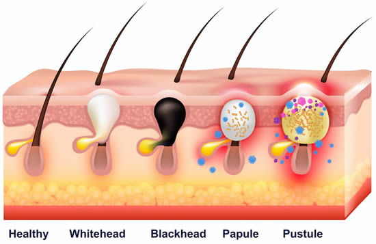 types-of-acne