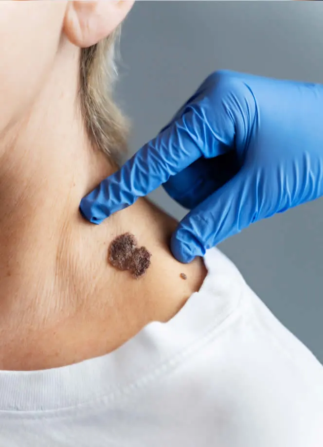 happy mature woman close-up-hand-touching-skin-with-melanoma