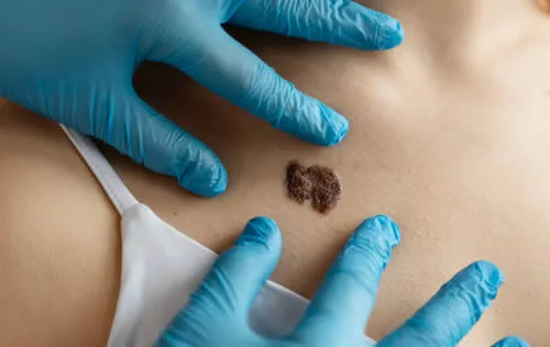age-spots mole on back
